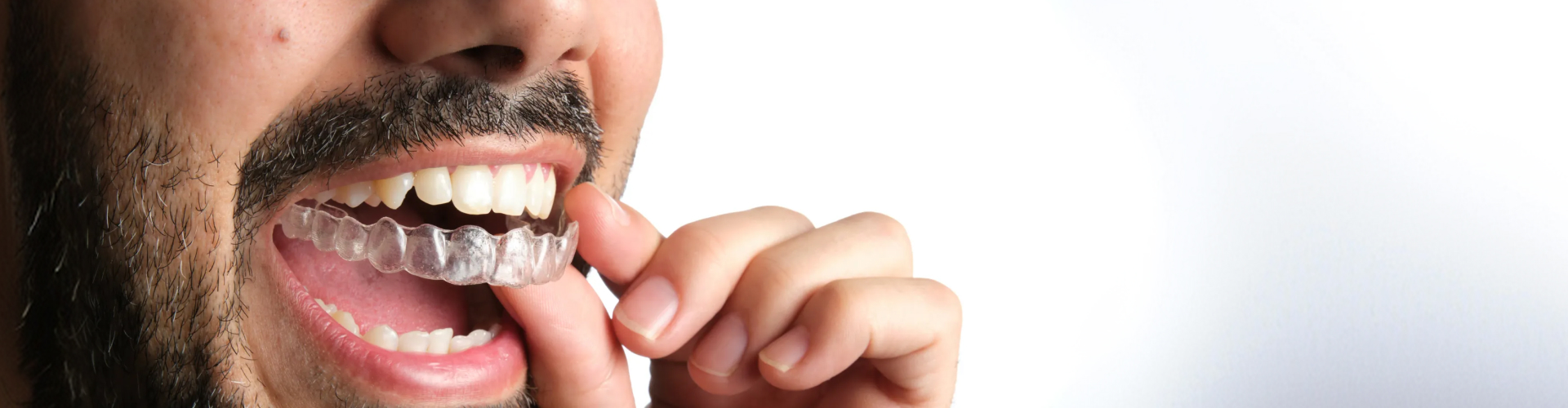 Closeup of man placing clear aligner in his mouth.